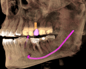 cone beam scanner 3D implant