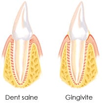 gencive gingivite