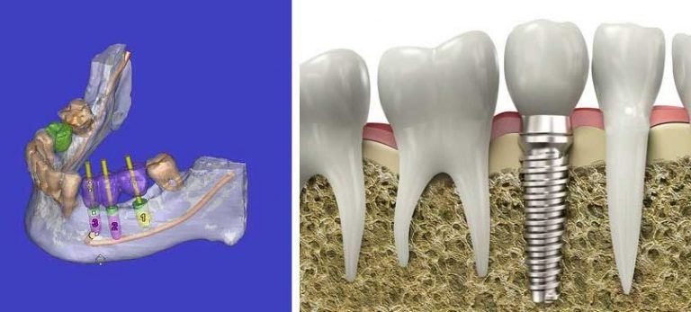 Implant dentaire  Dentiste La Rochelle