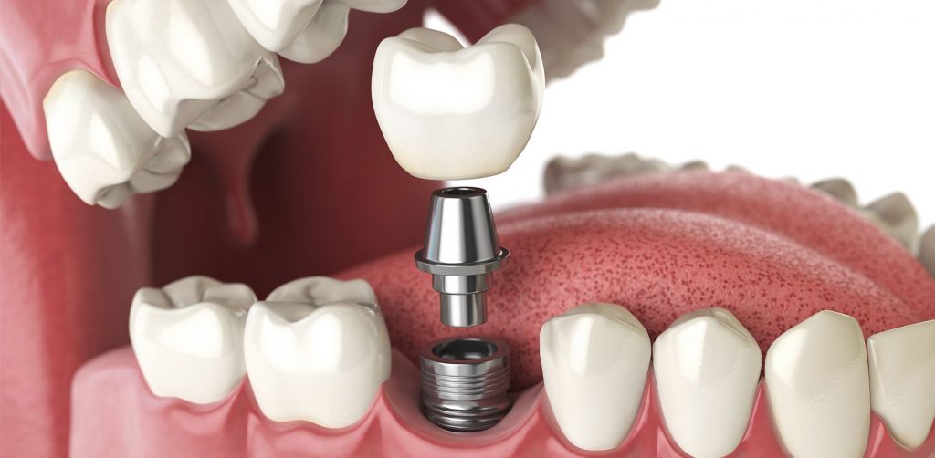 Enlever un amalgame dentaire (plombage) - Dentiste La Rochelle